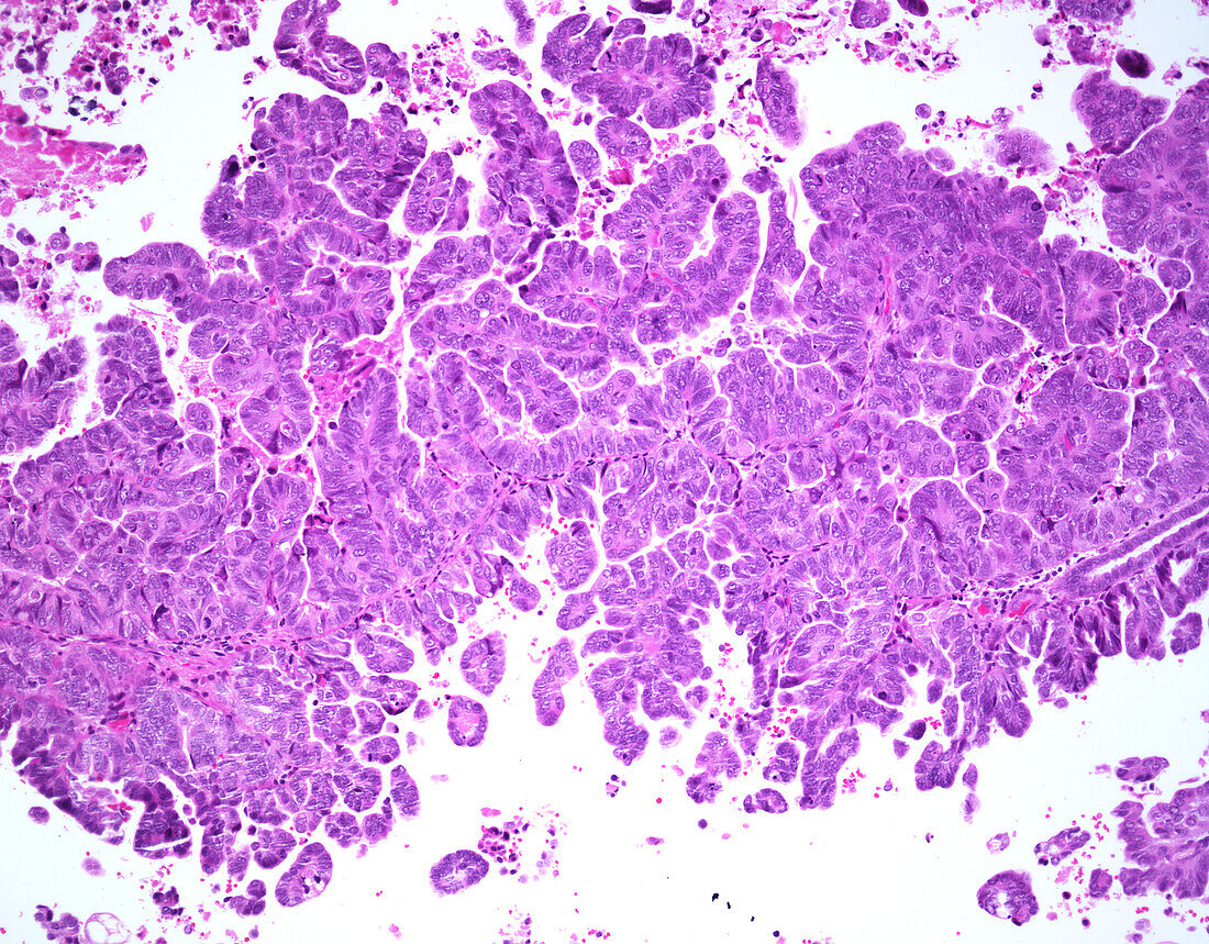 Serous carcinoma, light micrograph