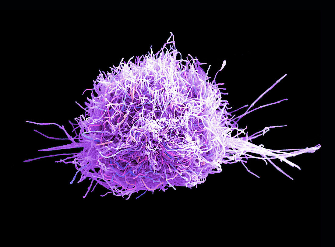 Cervical cancer cell, SEM