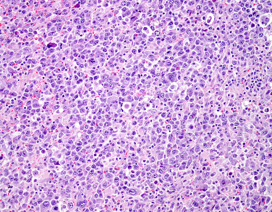 Diffuse large B cell lymphoma, light micrograph