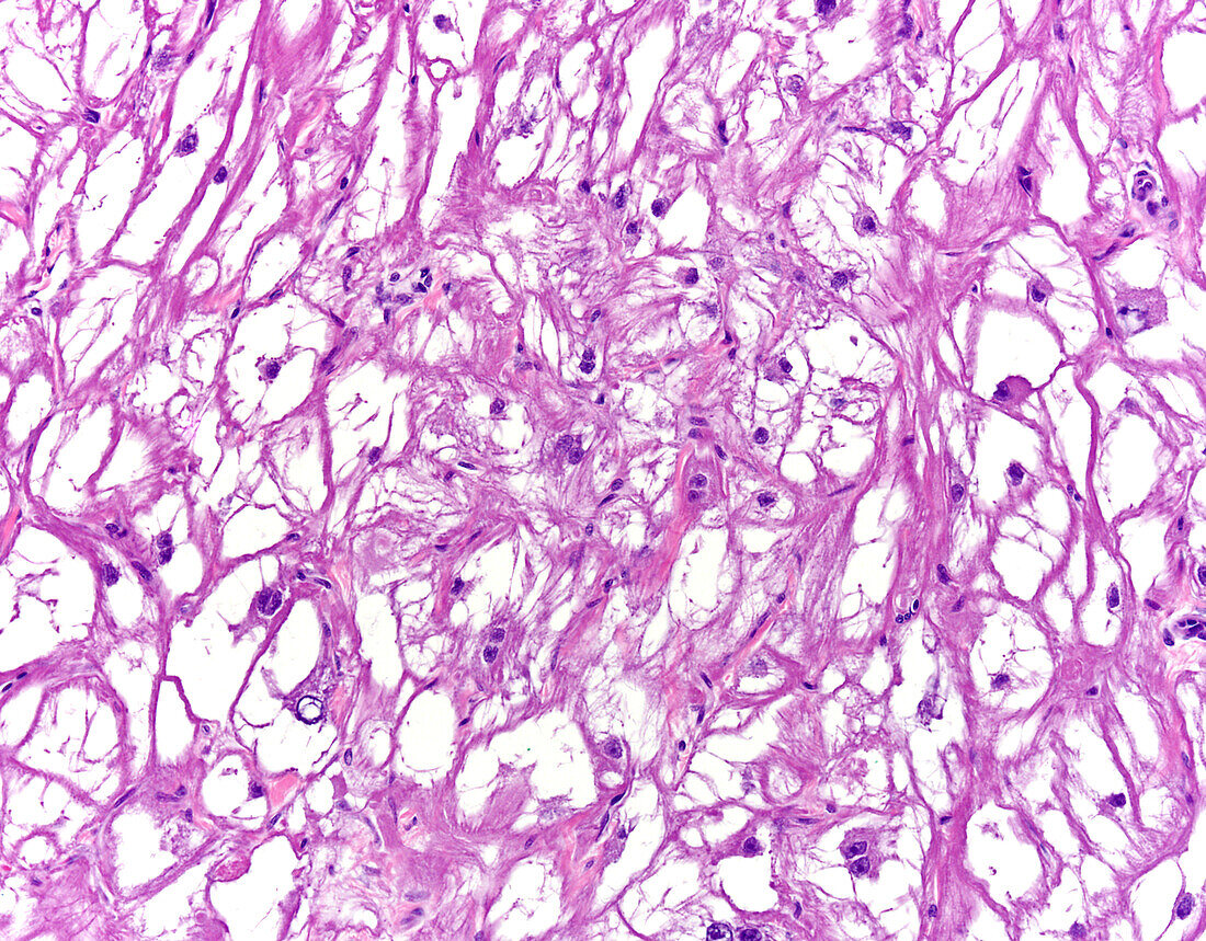 Cardiac rhabdomyoma, light micrograph