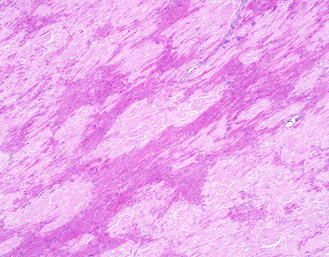 Familial amyloidosis, light micrograph