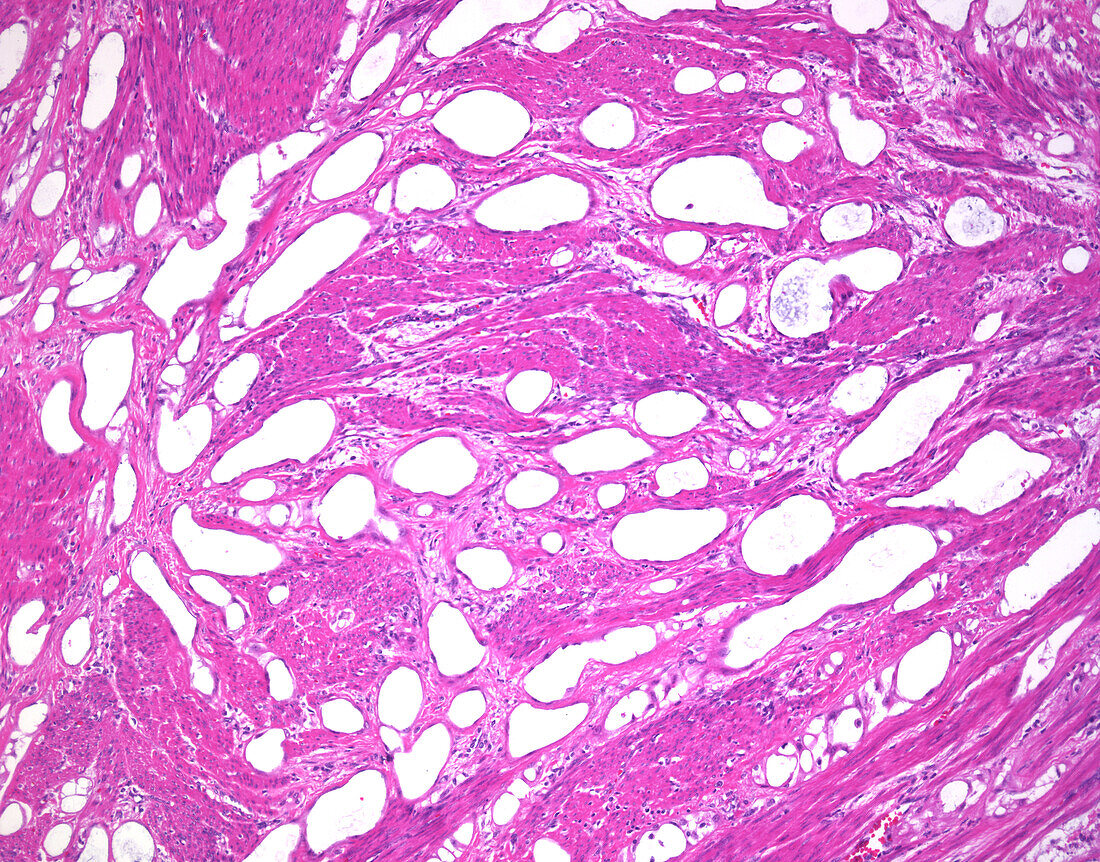 Adenomatoid tumour, light micrograph