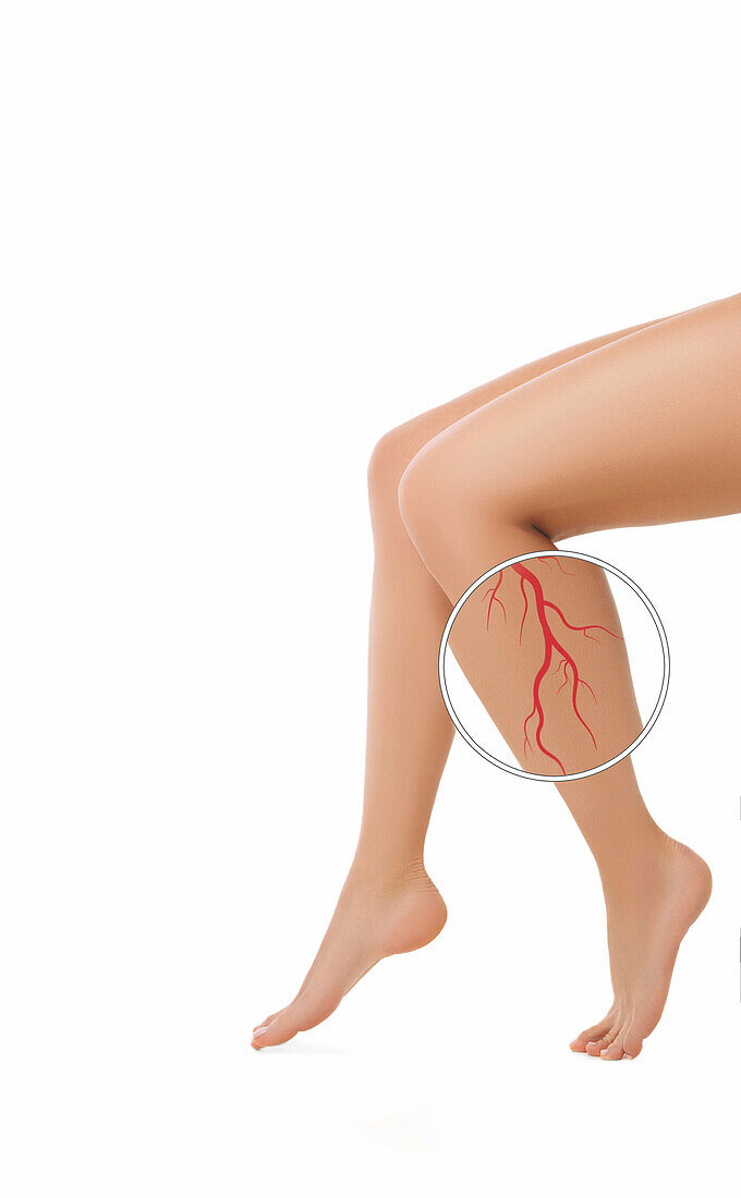 Varicose veins, conceptual image