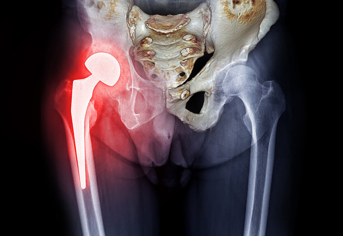 Hip replacement, MRI scan and X-ray