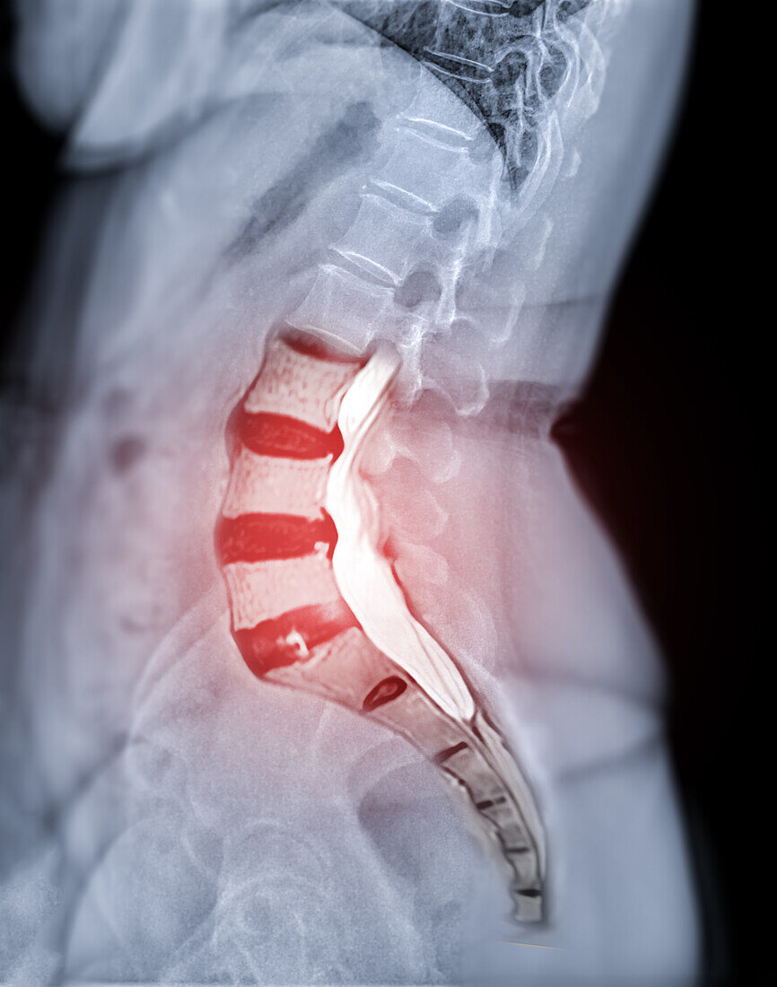 Compressed spinal cord, X-ray