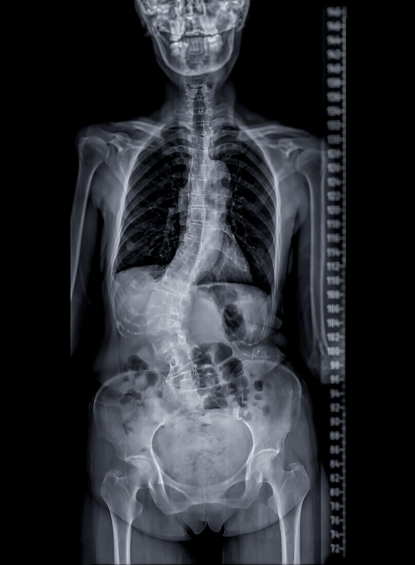 Scoliosis of the spine, X-ray