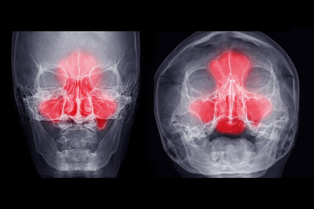 Sinus pain, conceptual X-rays