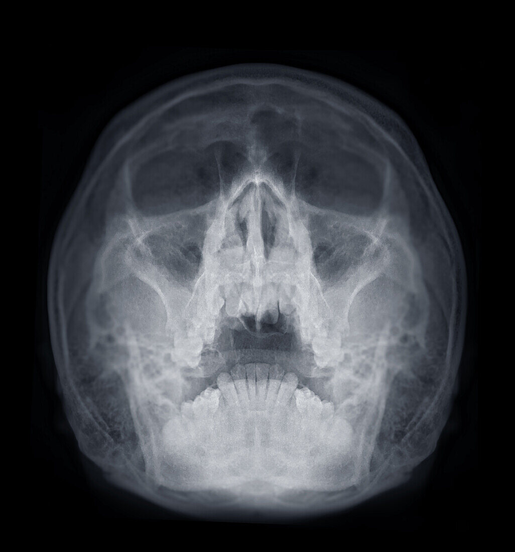 Healthy sinuses, X-ray