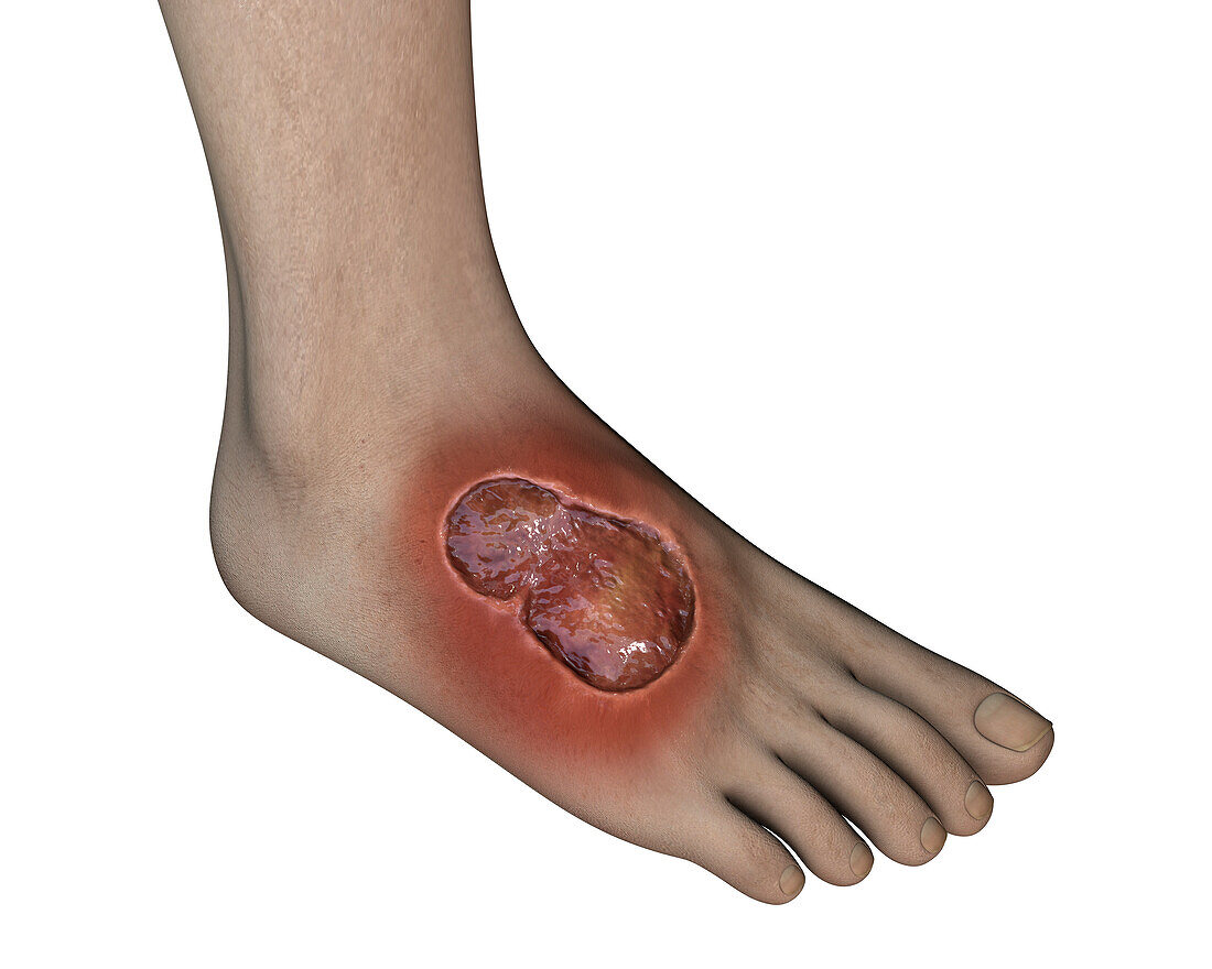 Buruli ulcer on a foot, illustration