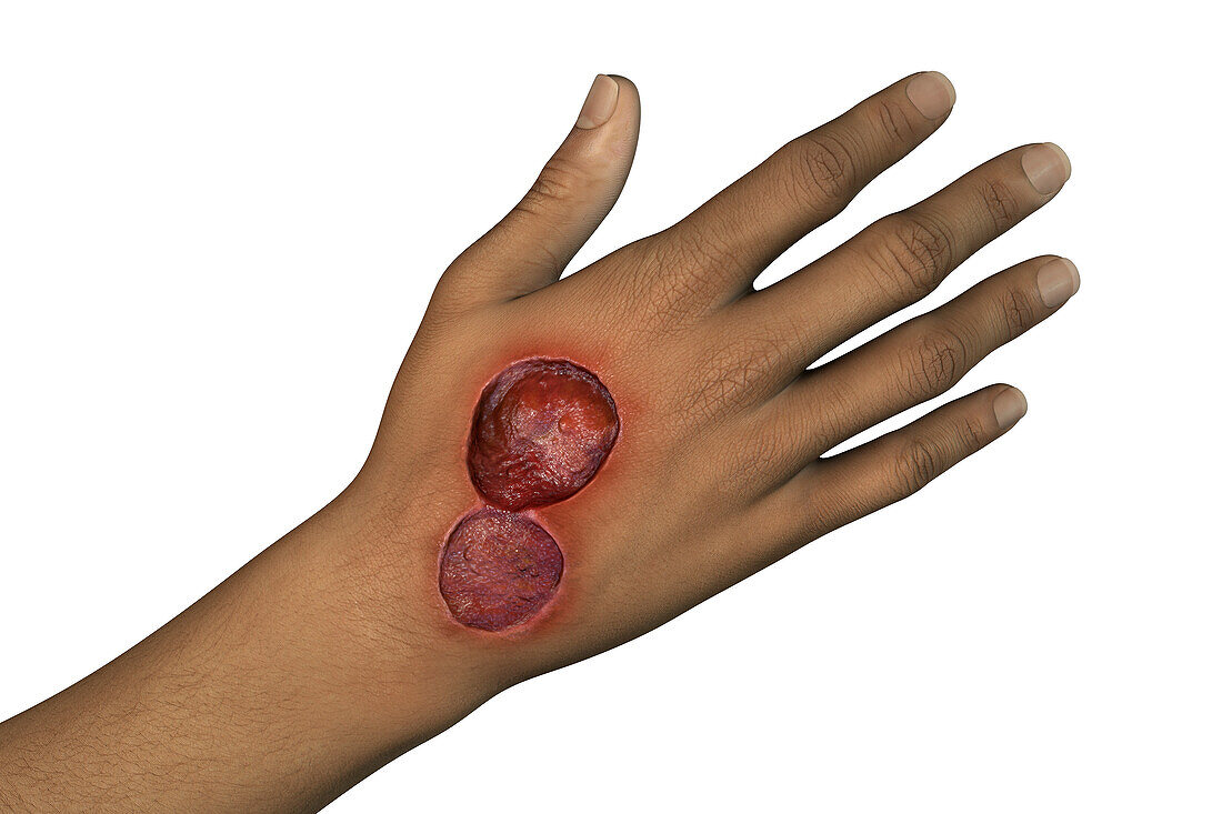 Buruli ulcer on a hand, illustration