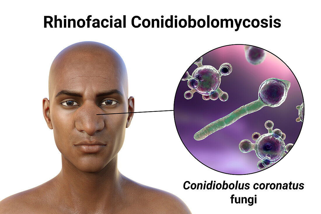 Rhinofacial conidiobolomycosis and fungus, illustration