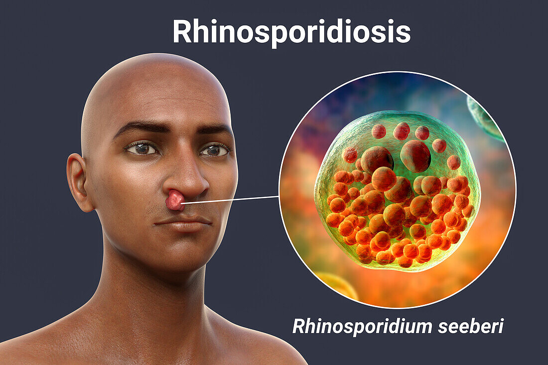 Nasal rhinosporidiosis, illustration