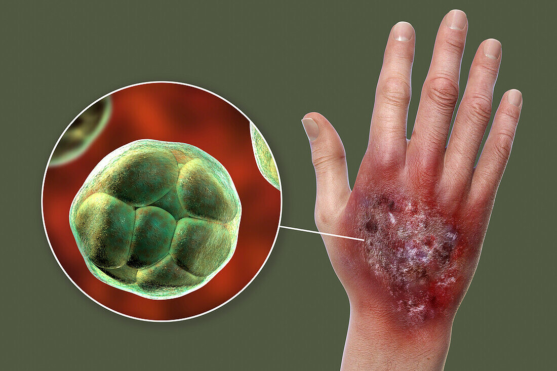 Protothecosis infection on a human hand, illustration