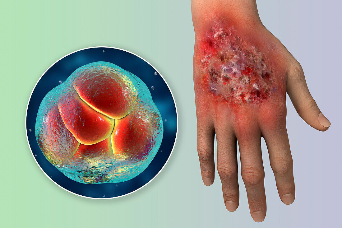 Protothecosis infection on a human hand, illustration