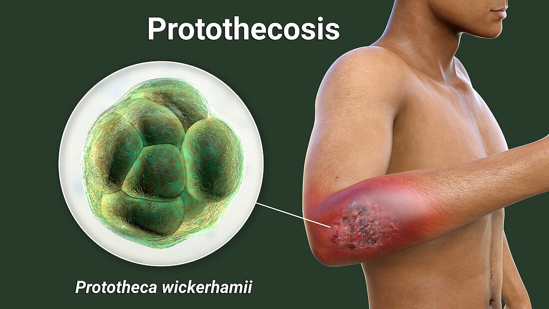Protothecosis infection on a human elbow, illustration