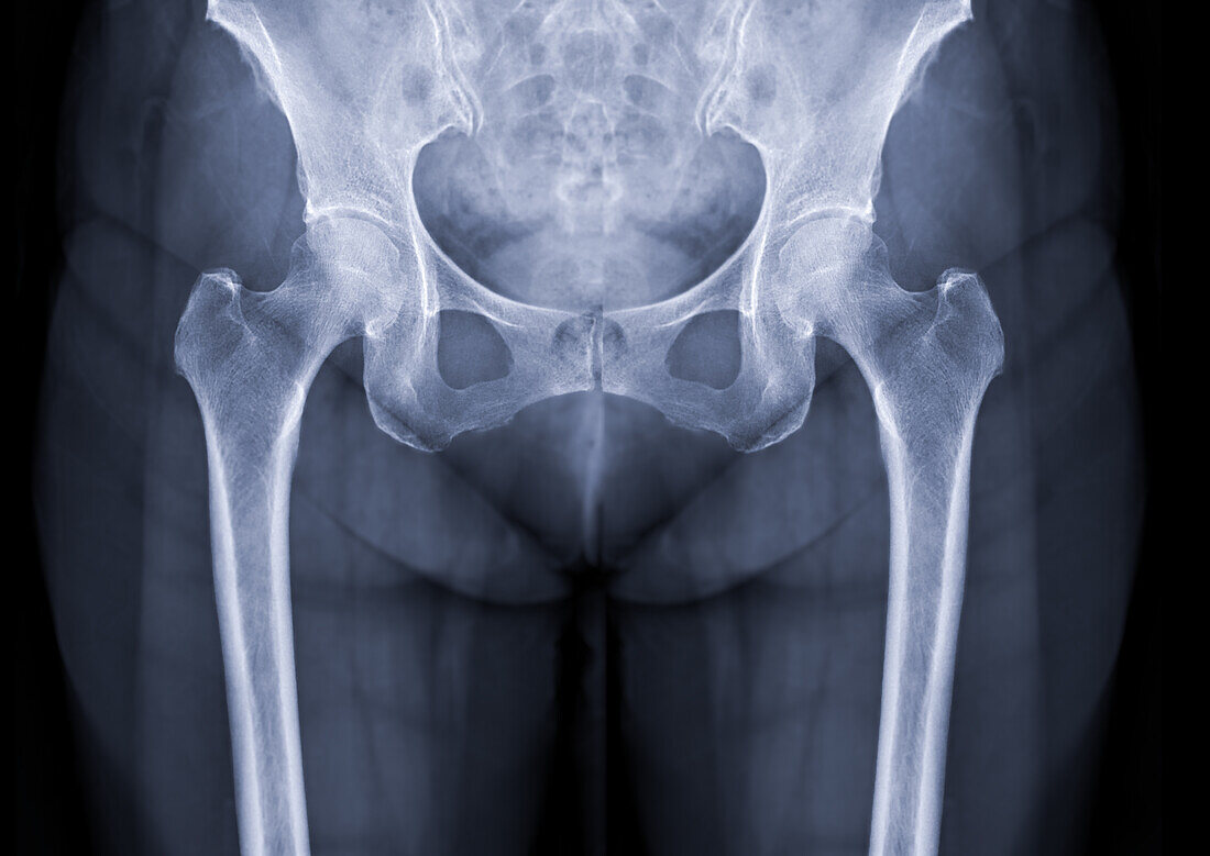 Healthy hip joints, X-ray