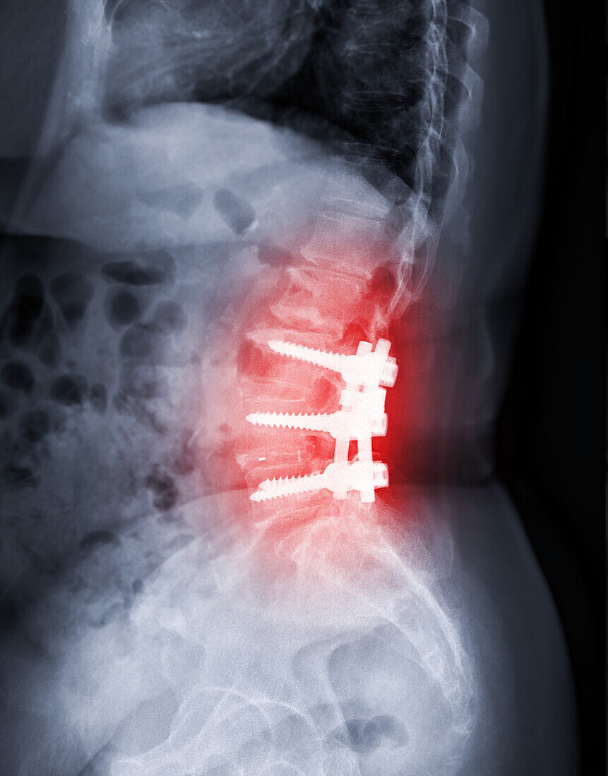 Spinal stenosis after surgery, X-ray