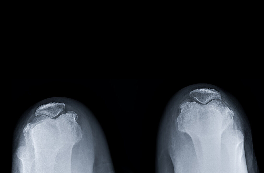 Healthy knees, X-ray
