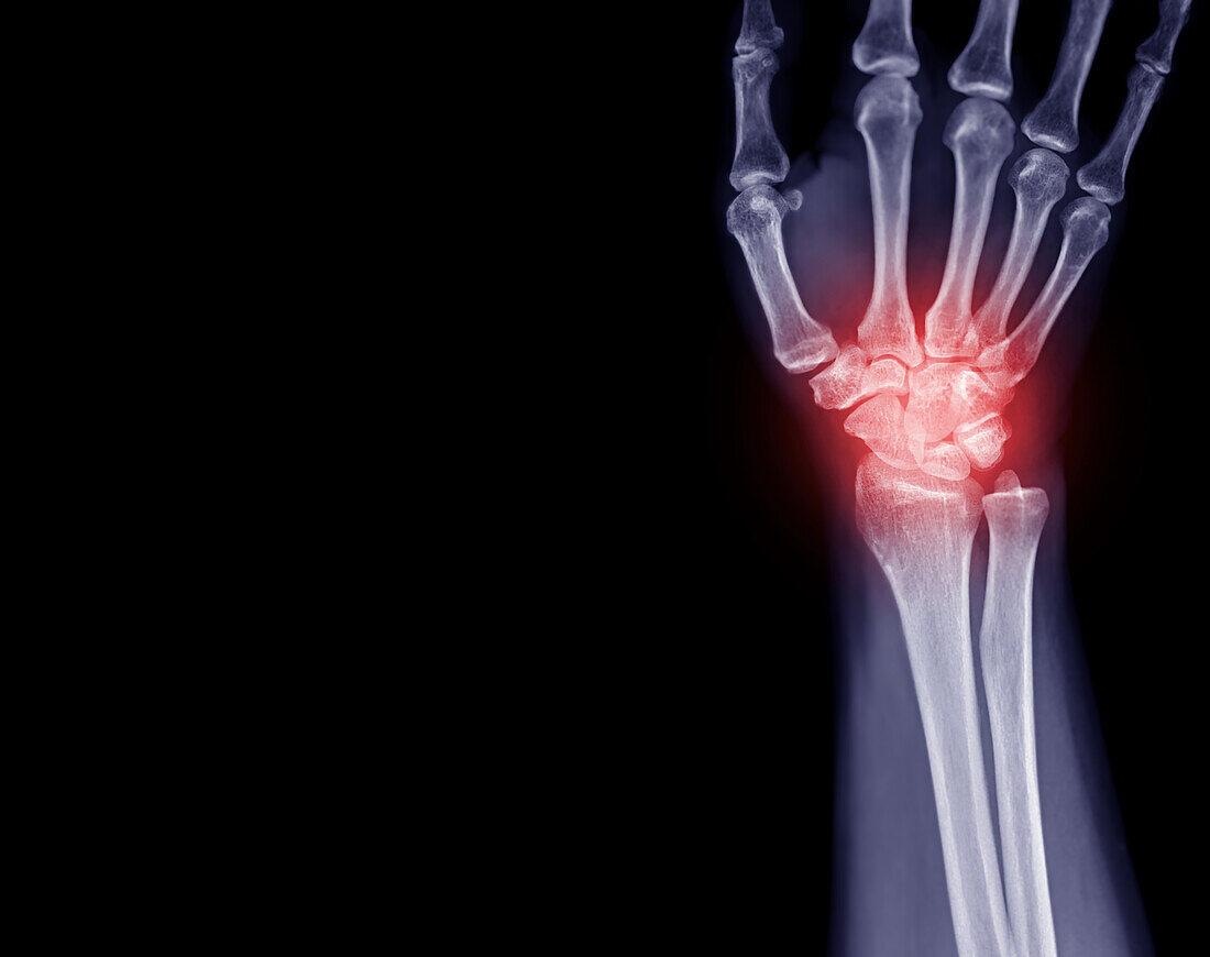 Wrist pain, conceptual X-ray