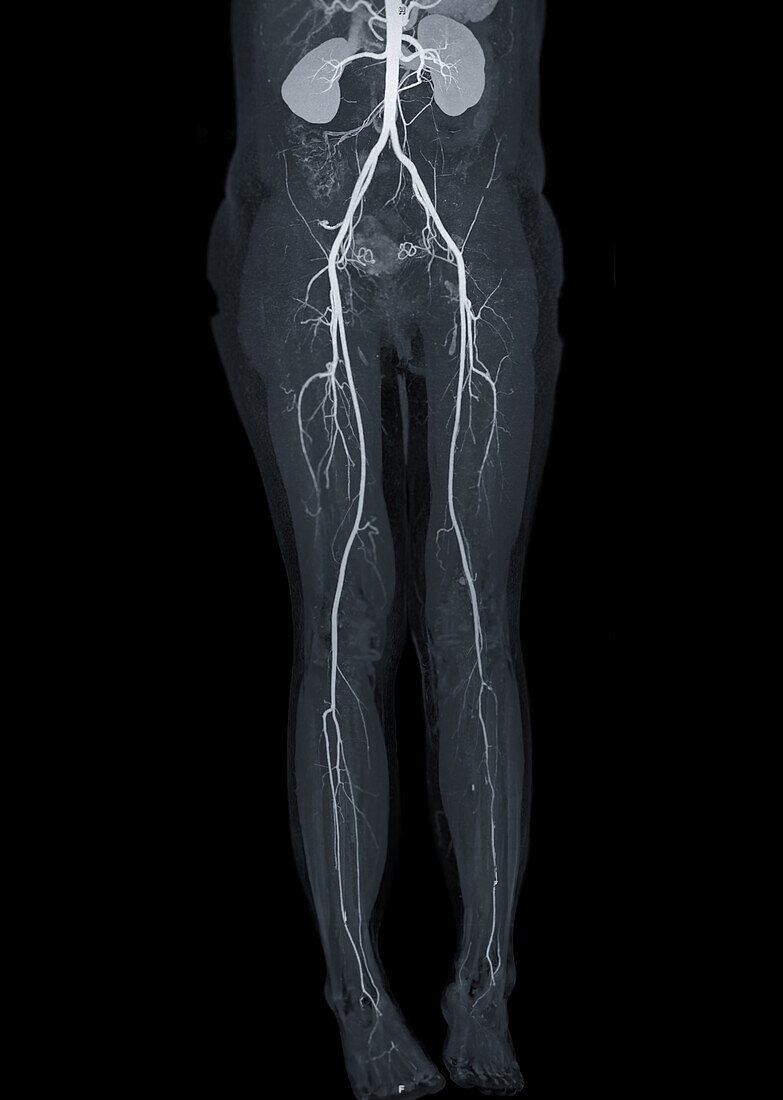 Healthy abdomen and lower body, X-ray