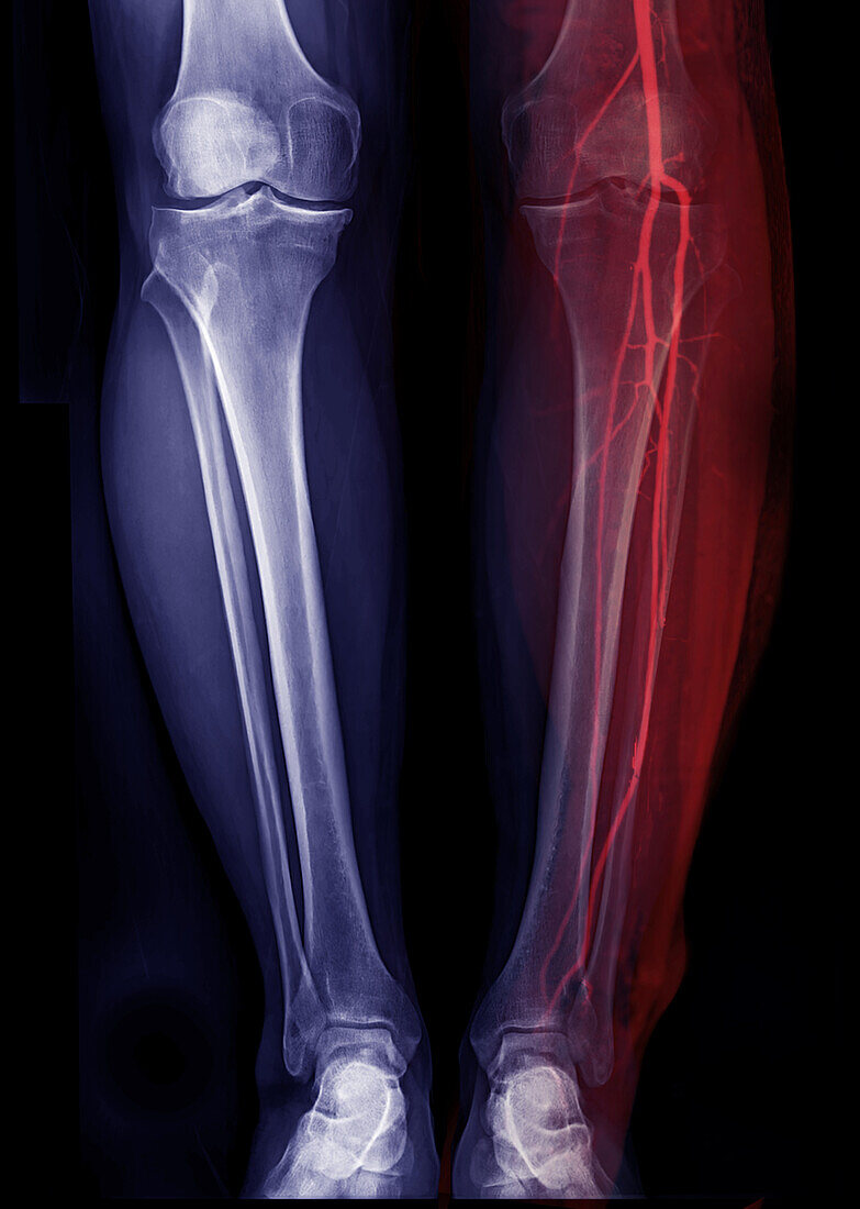 Lower legs, X-rays