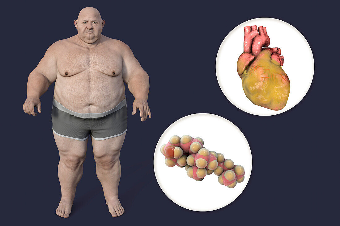 Cholesterol and fatty heart in overweight man, illustration
