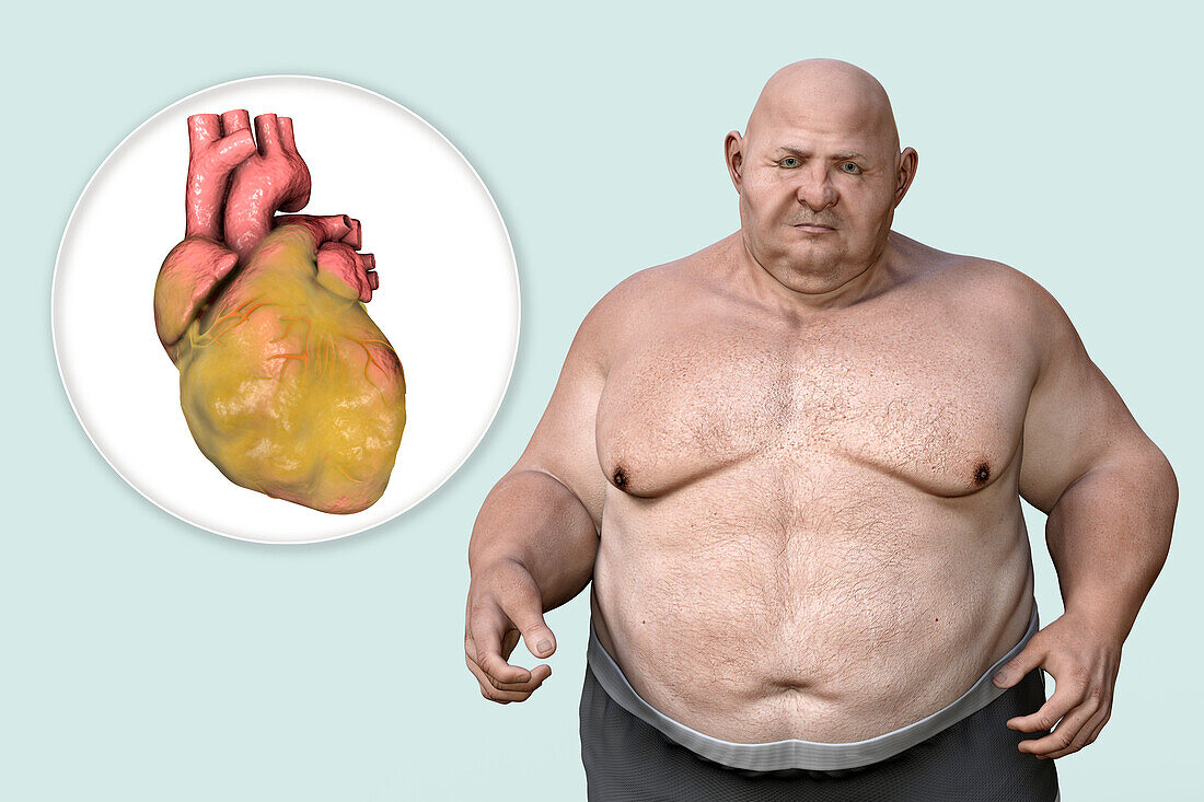 Fatty heart in overweight man, illustration.