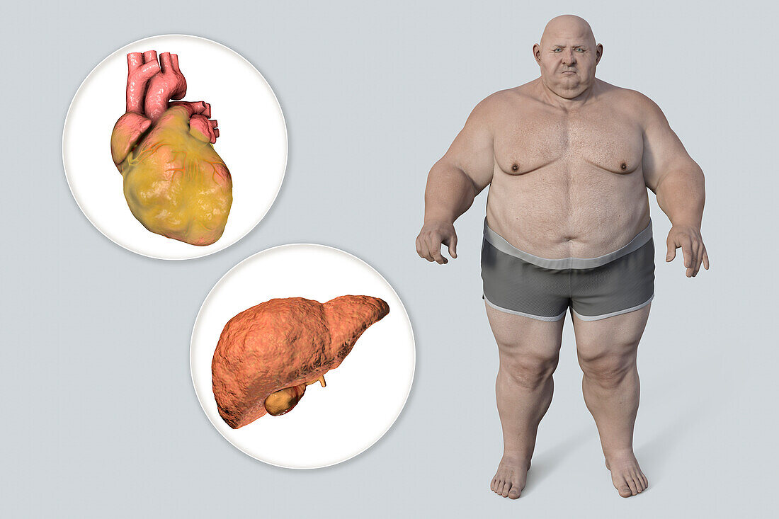 Fatty heart and liver in overweight man, illustration.