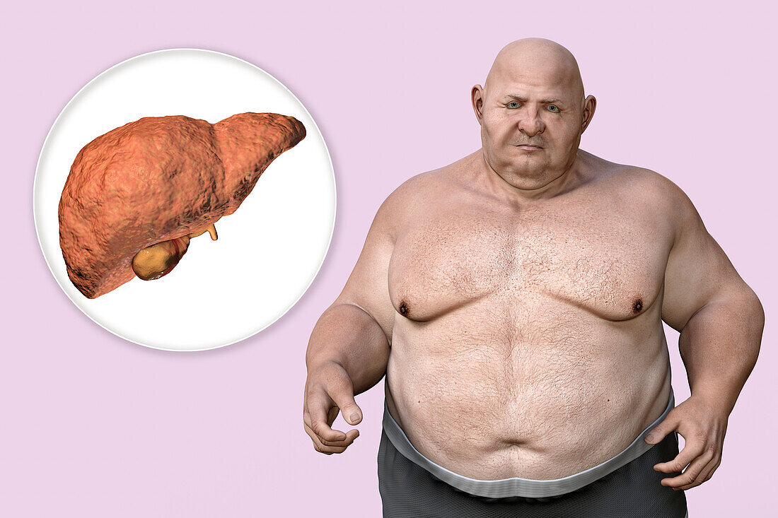 Fatty liver disease in an overweight man, illustration