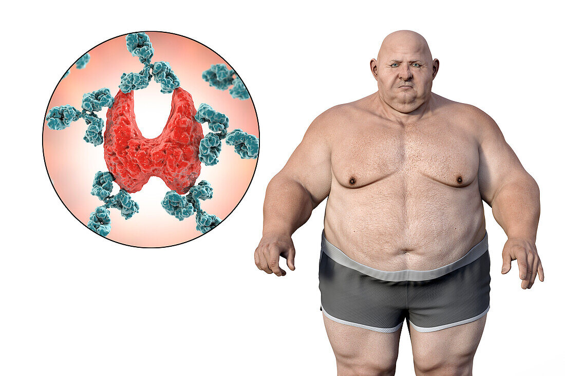 Autoimmune thyroid disease and obesity, illustration