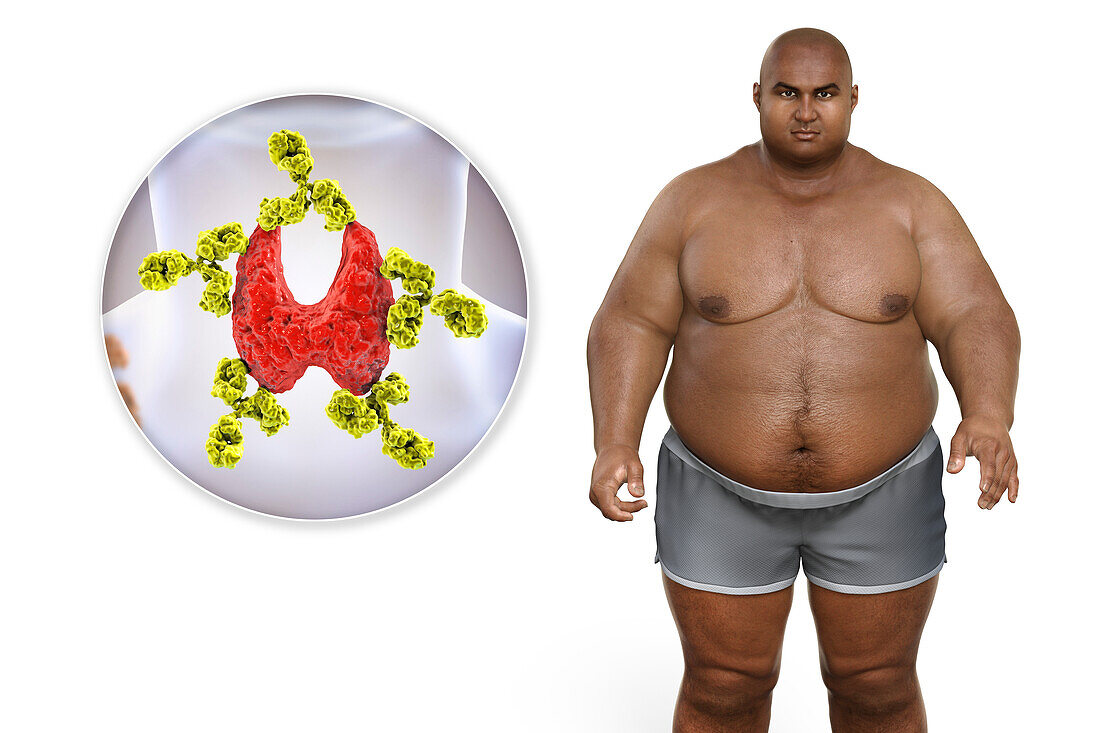 Autoimmune thyroid disease and obesity, illustration