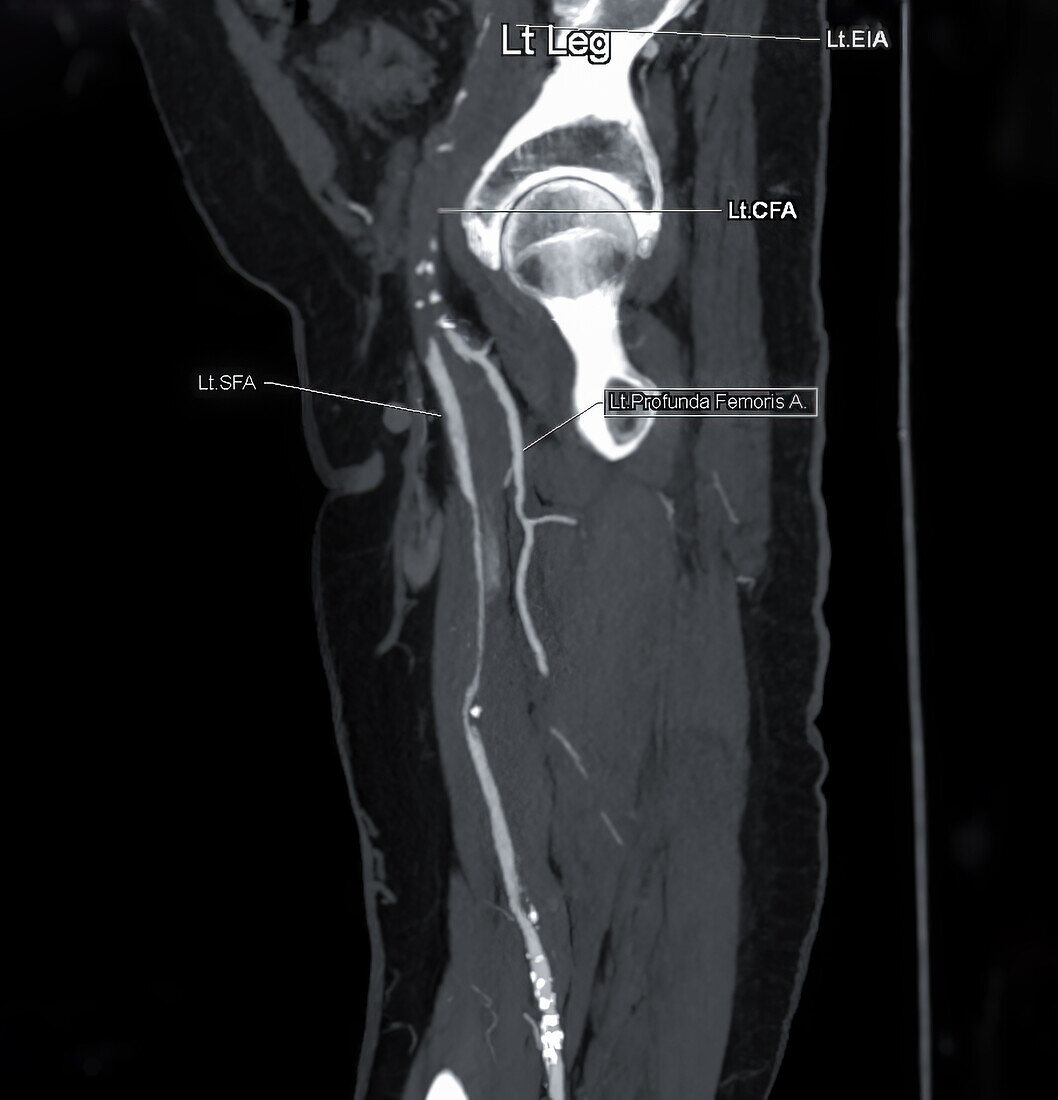 Thigh arteries, CT scan