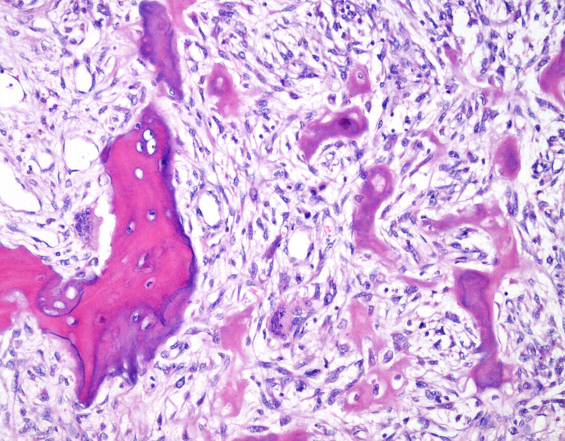 Osteosarcoma in Paget disease of bone, light micrograph