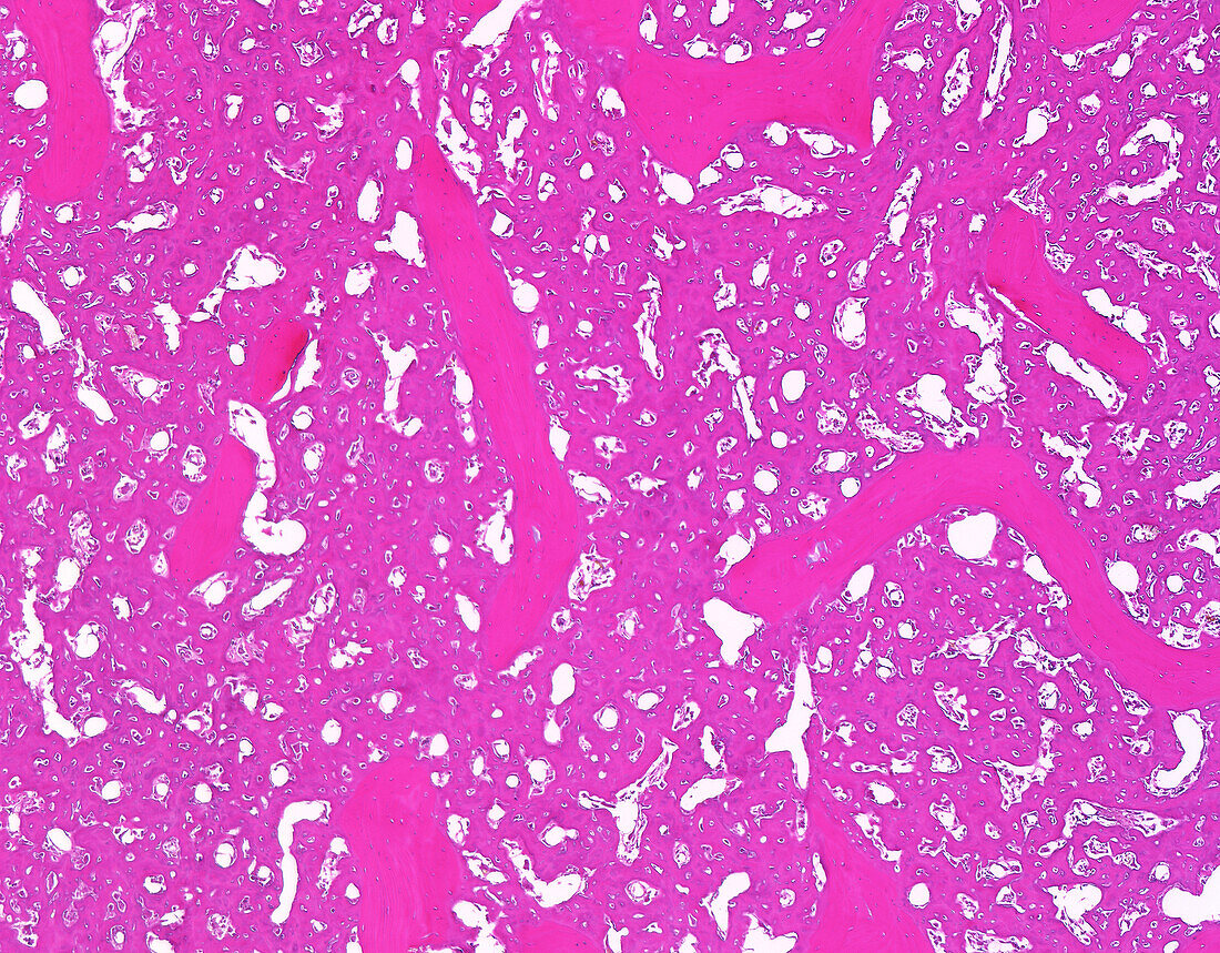 Osteoblastic osteosarcoma, light micrograph