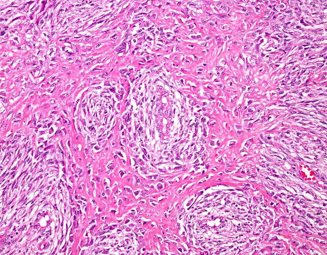 Fibroblastic osteosarcoma, light micrograph