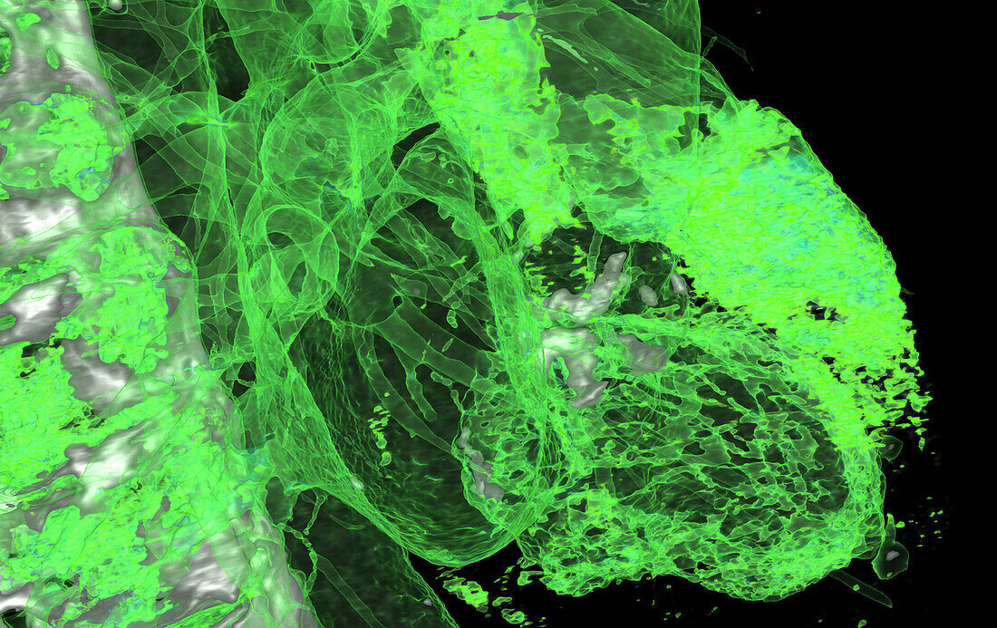 Calcified heart valve, CT scan