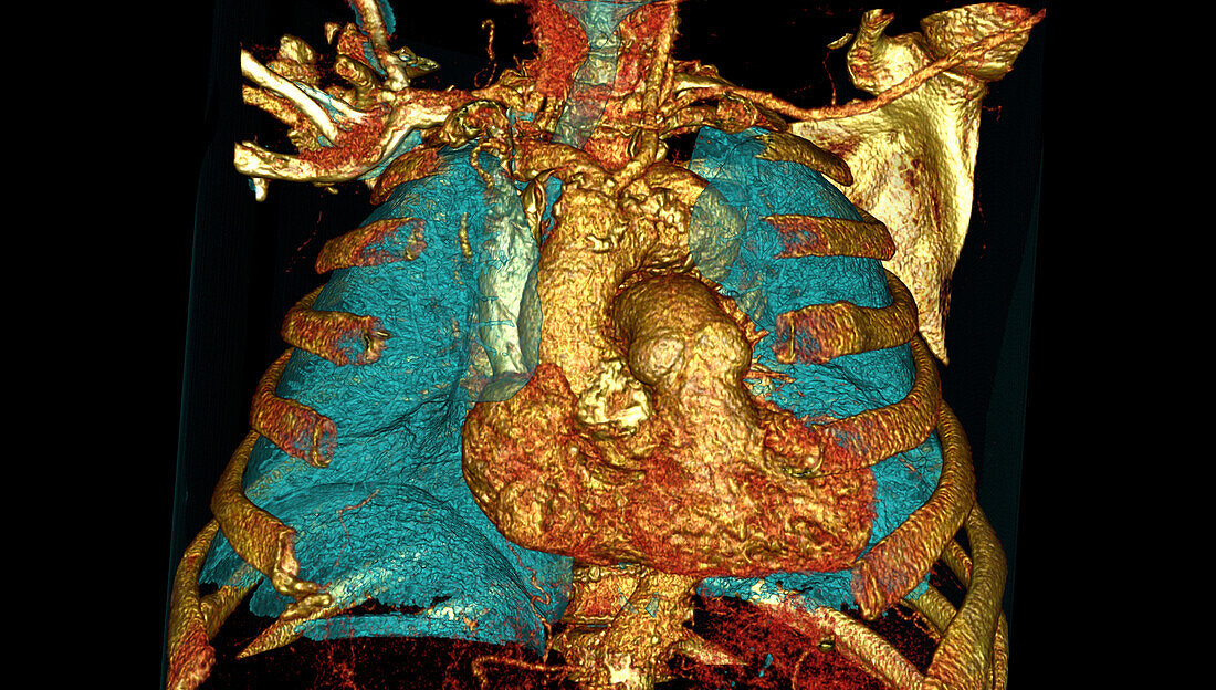 Bovine aortic arch variant, CT scan