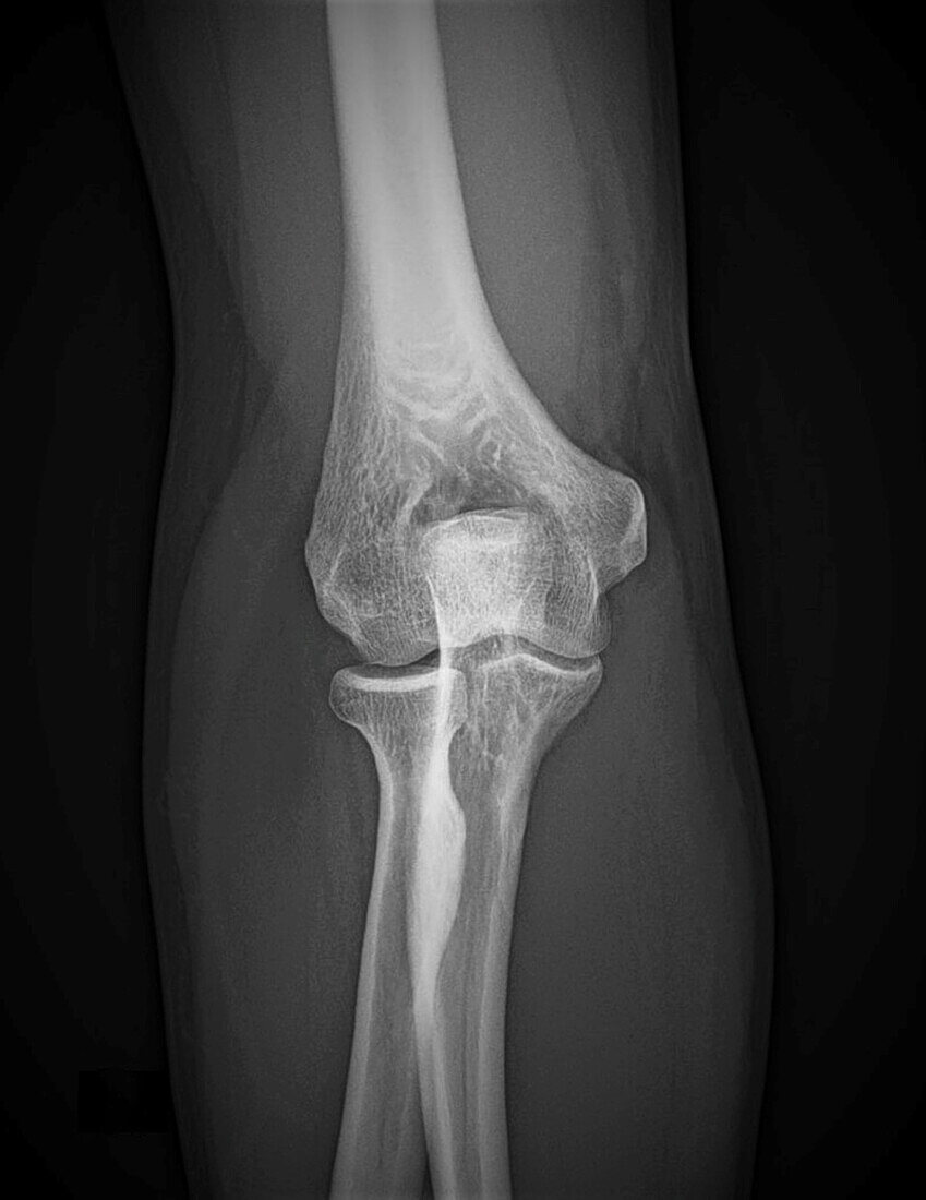 Healthy elbow joint, X-ray