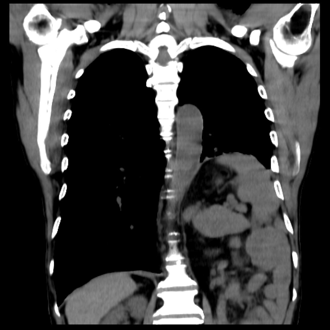 Hiatus hernia, CT scan