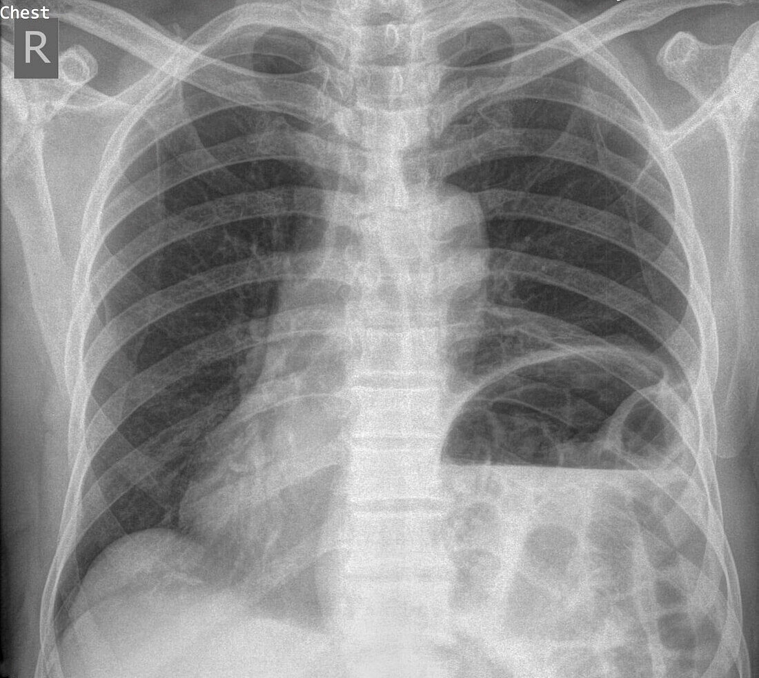 Hiatus hernia, X-ray