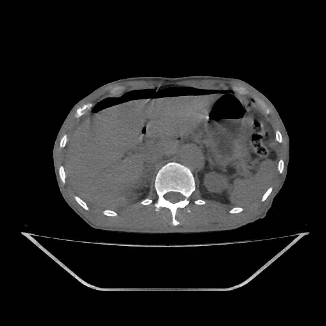 Pneumoperitoneum, CT scan
