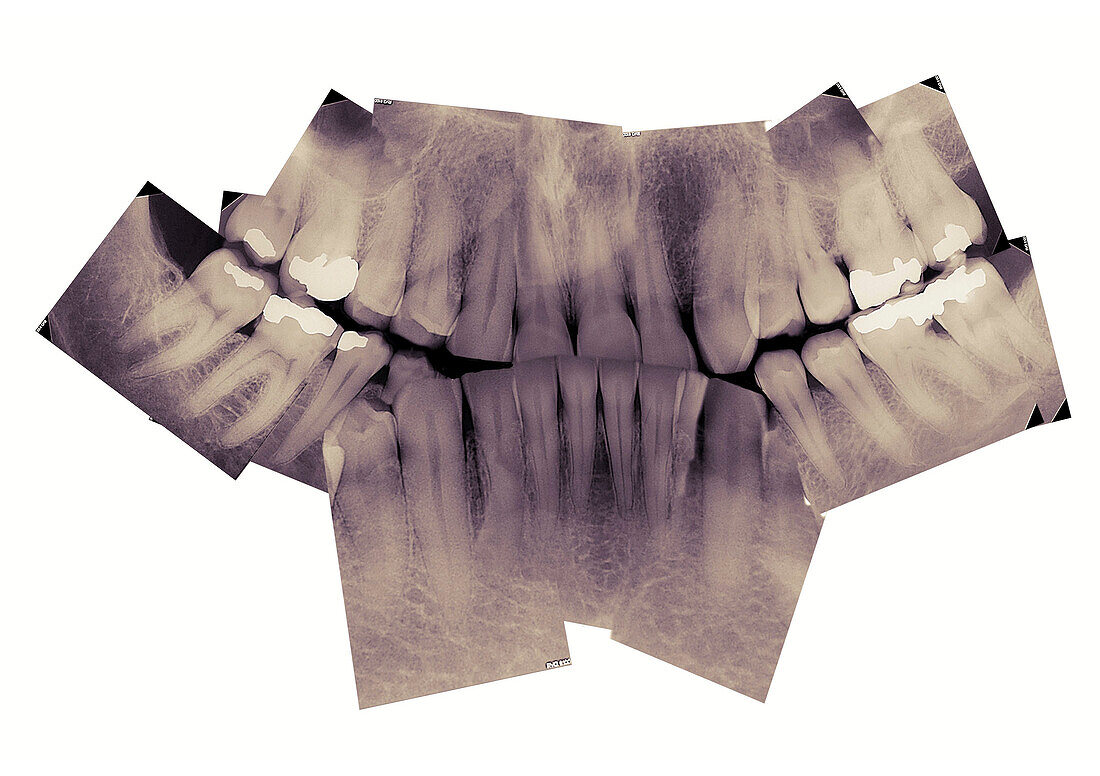 X-rays of Mature Teeth