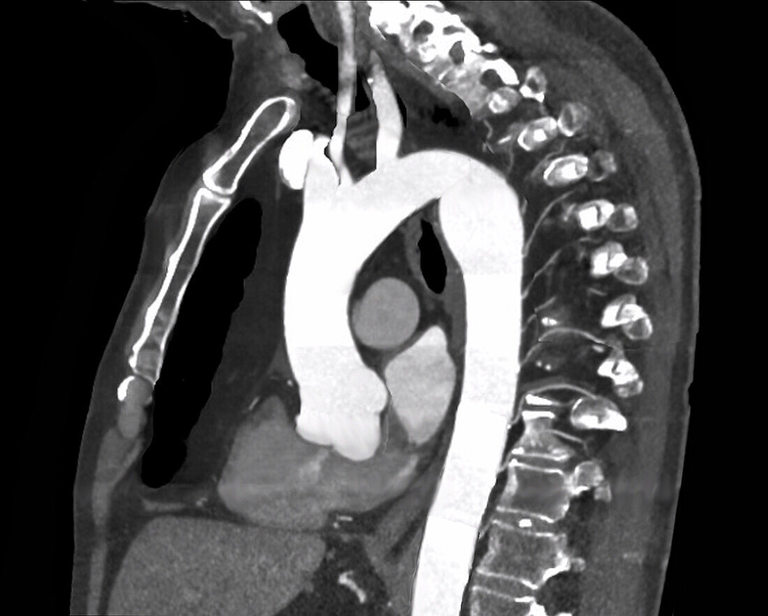 Aortic aneurysm, CT scan