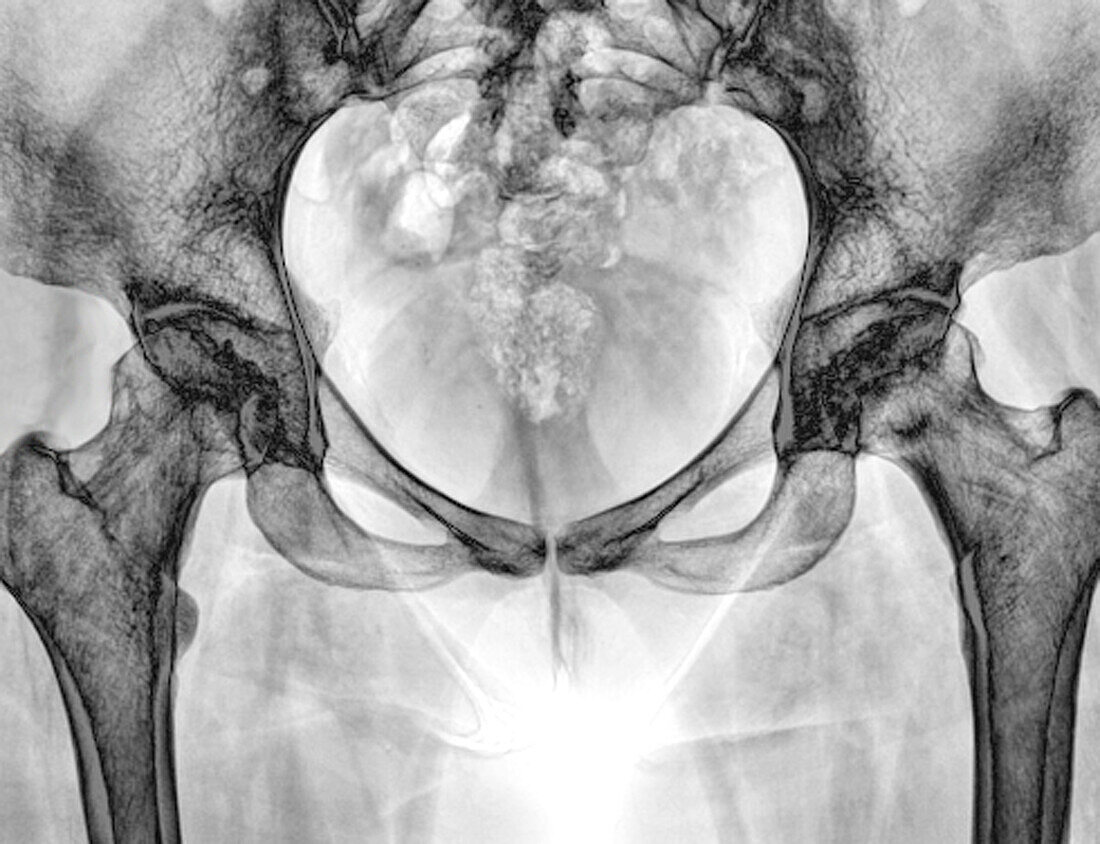 Hip disease, X-ray