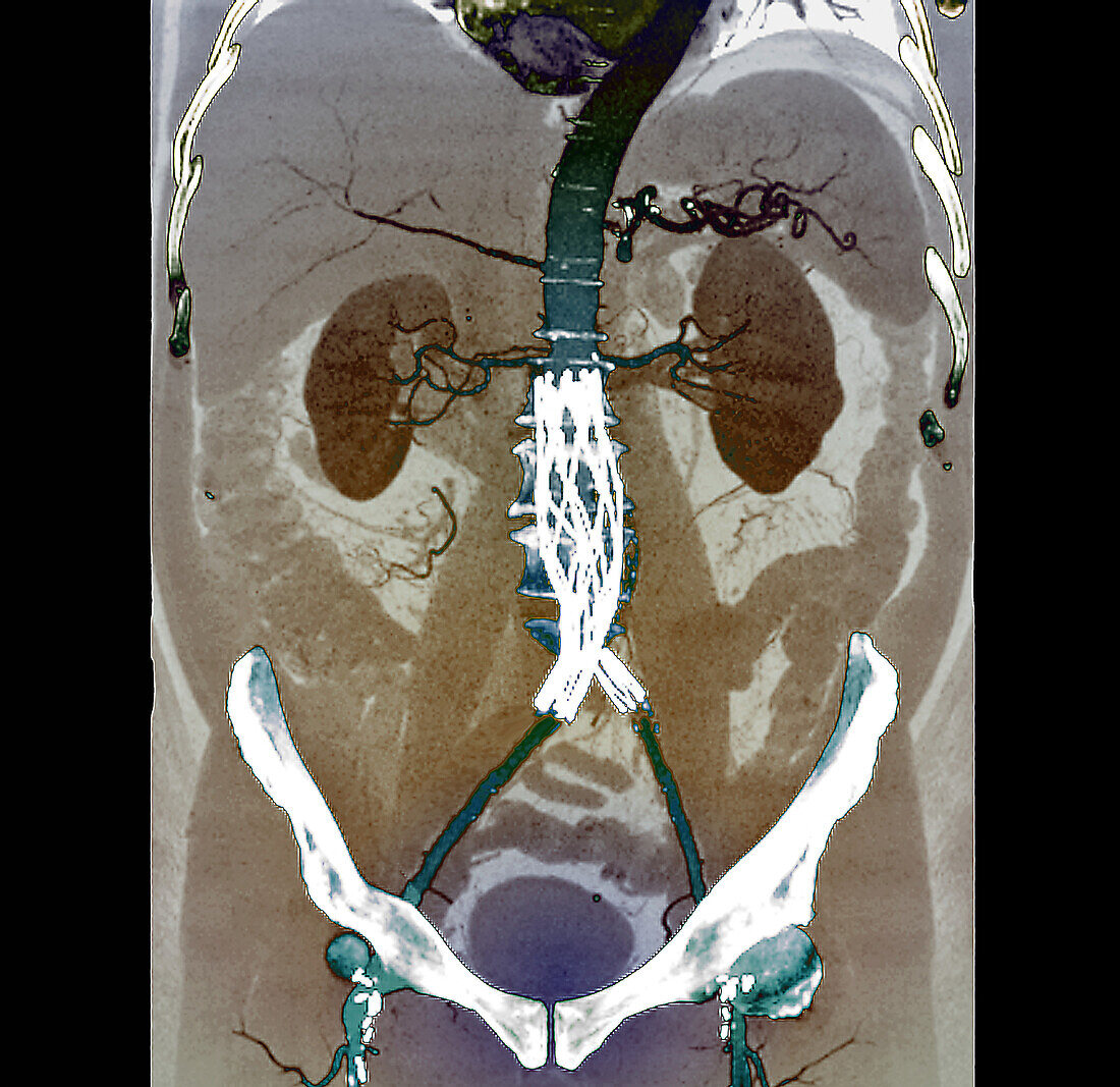 Aortic aneurysm stent, CT scan