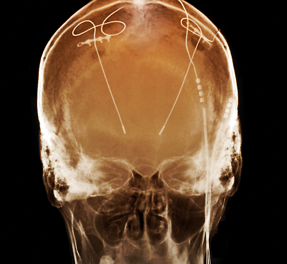 Parkinson's disease electrode implants, X-ray