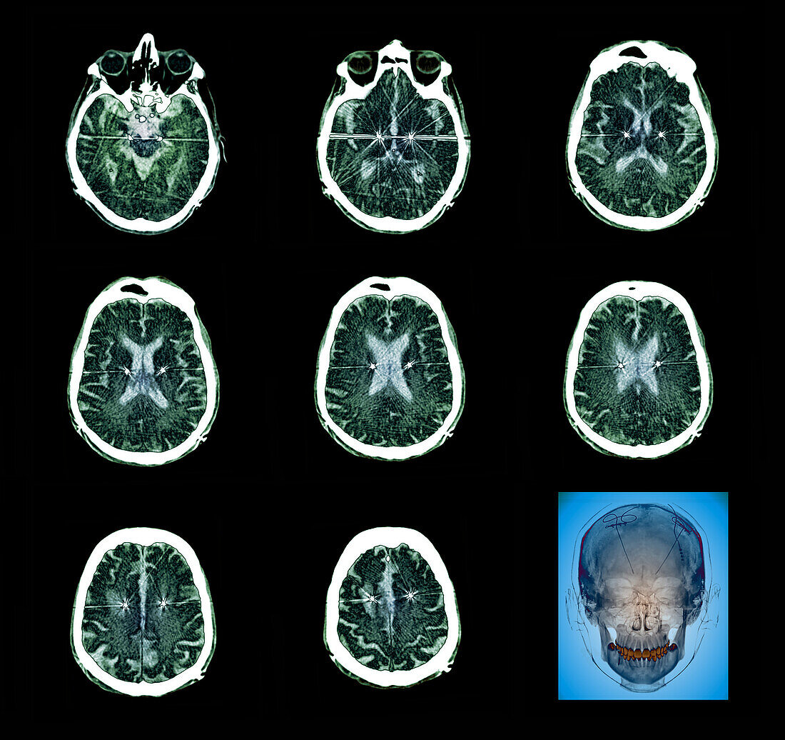Parkinson's disease electrode implants, CT scans