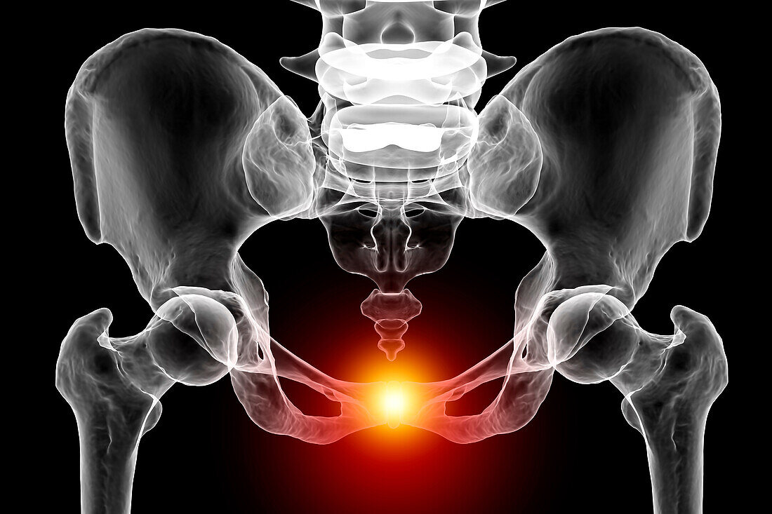 Symphysis pubis dysfunction, illustration