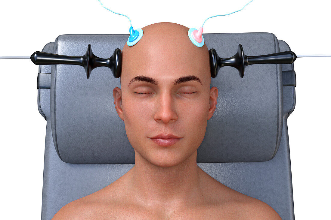 Electroconvulsive therapy, illustration