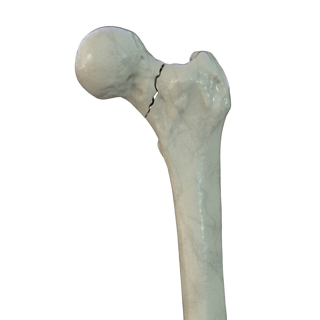 Fracture of the femur neck, illustration